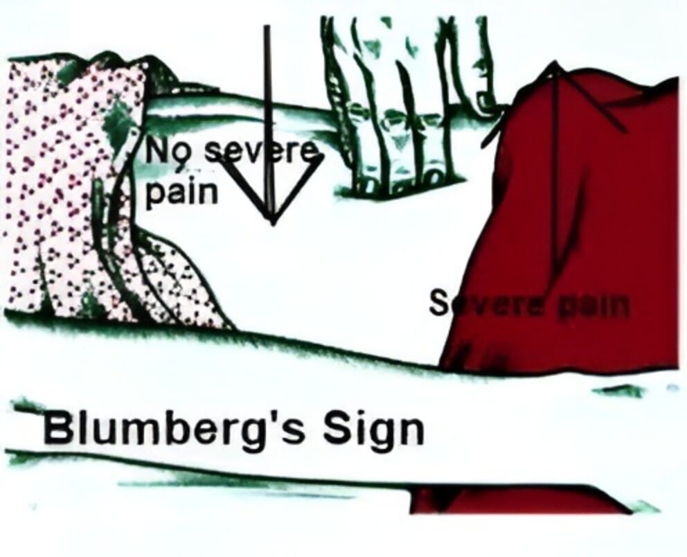 Gambar Blumberg Sign