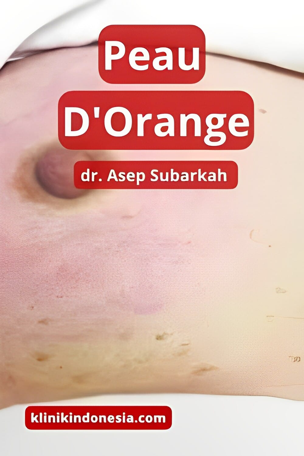 Gambar Peau D Orange