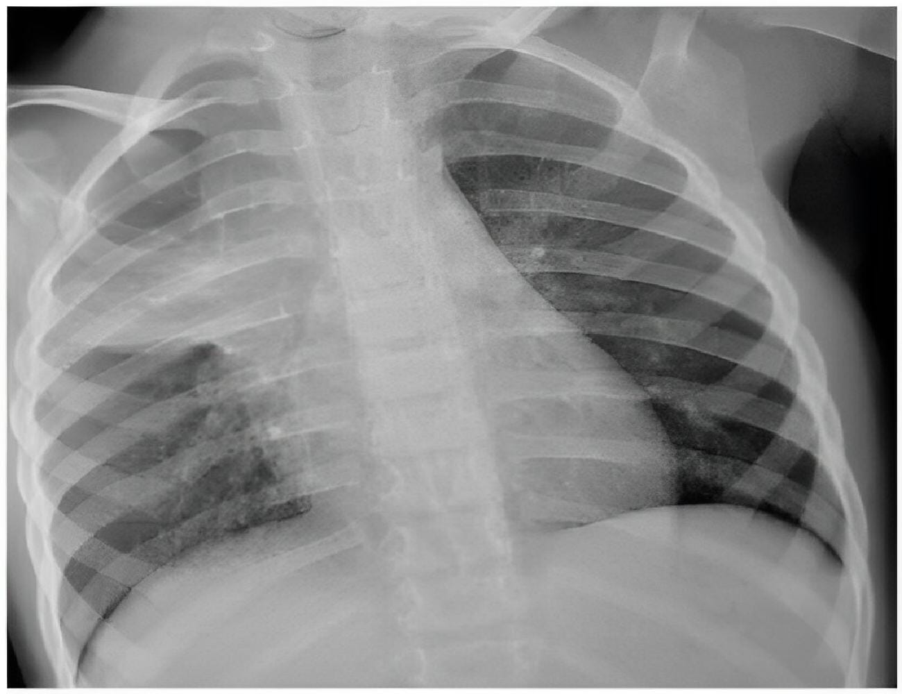 Gambar Tuberkulosis Primer