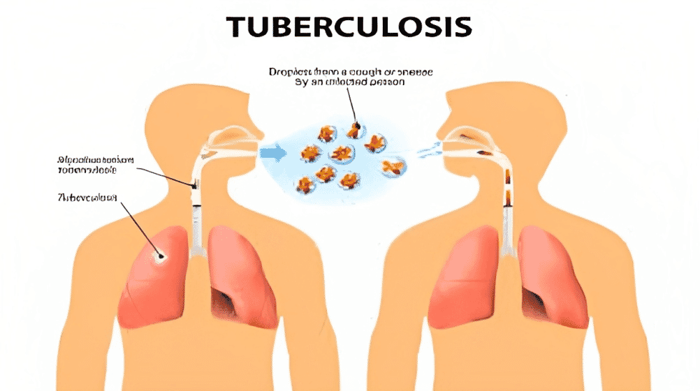 Gambar Tuberkulosis