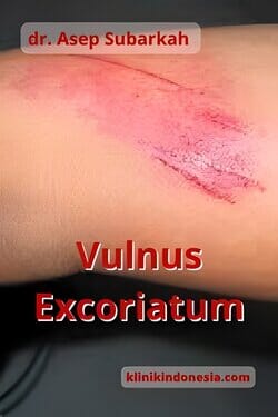 Gambar Vulnus Excoriatum