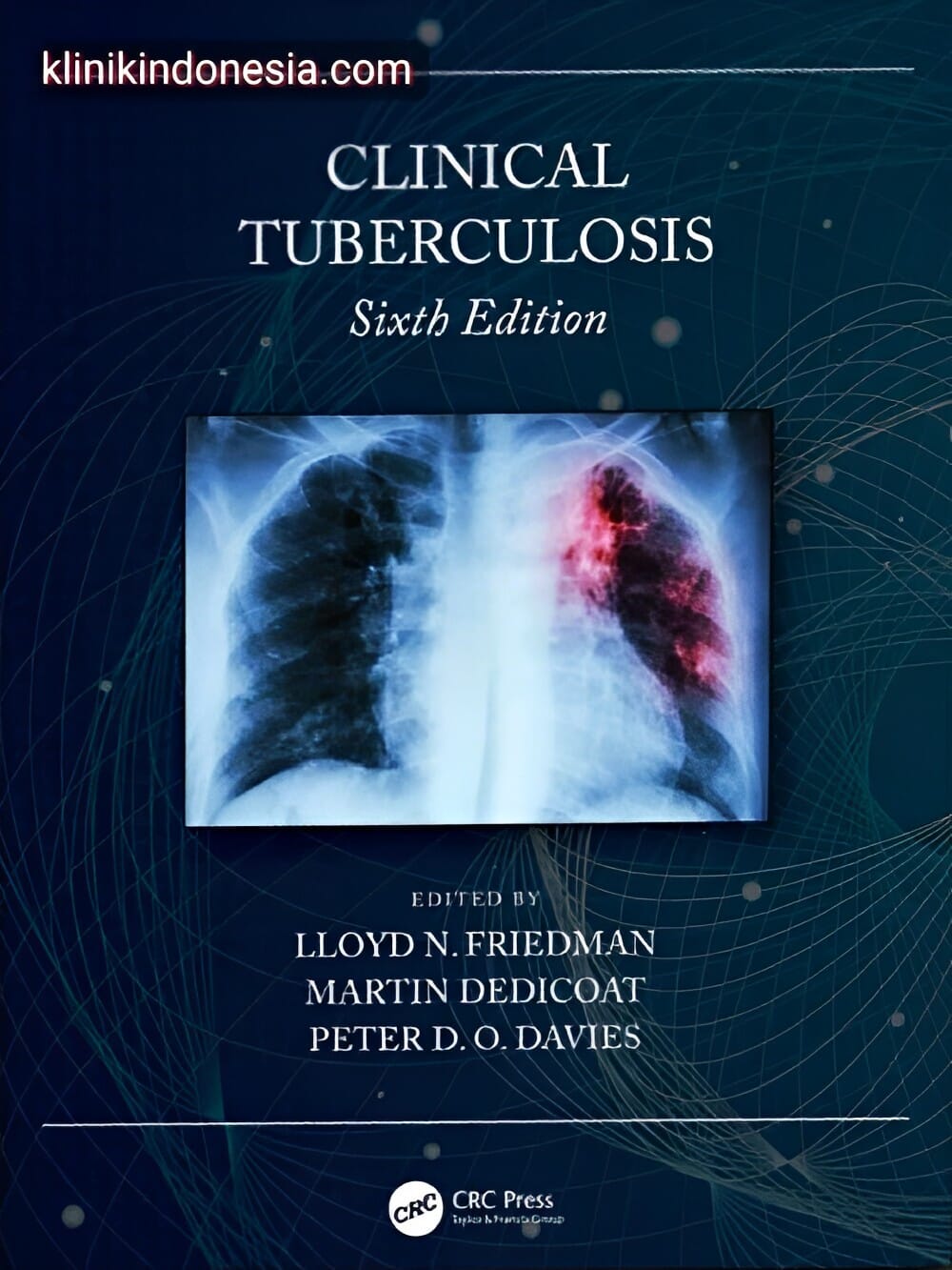 Gambar Clinical Tuberculosis