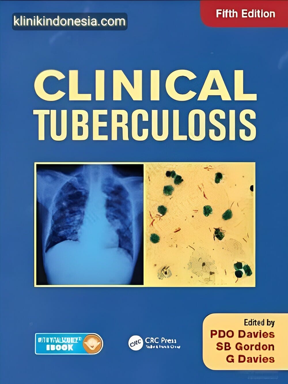 Gambar CD Ebook Clinical Tuberculosis Fifth Edition