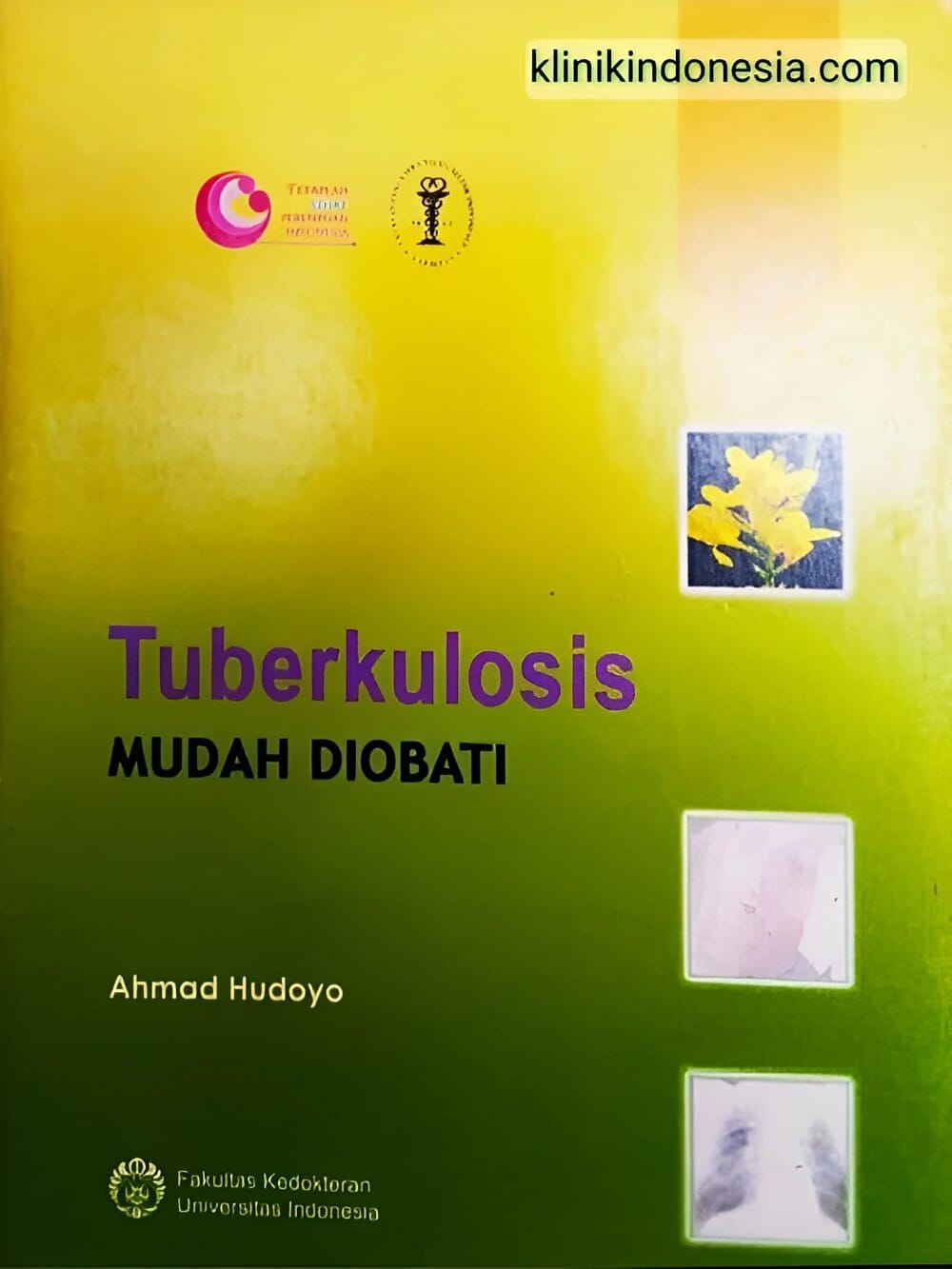 Gambar Tuberkulosis Mudah Diobati